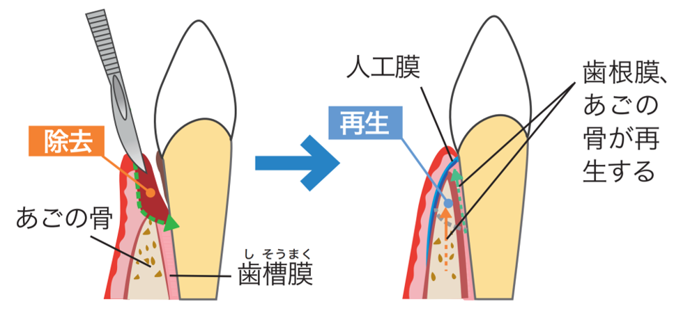 インプラント治療の例 （②難症例）