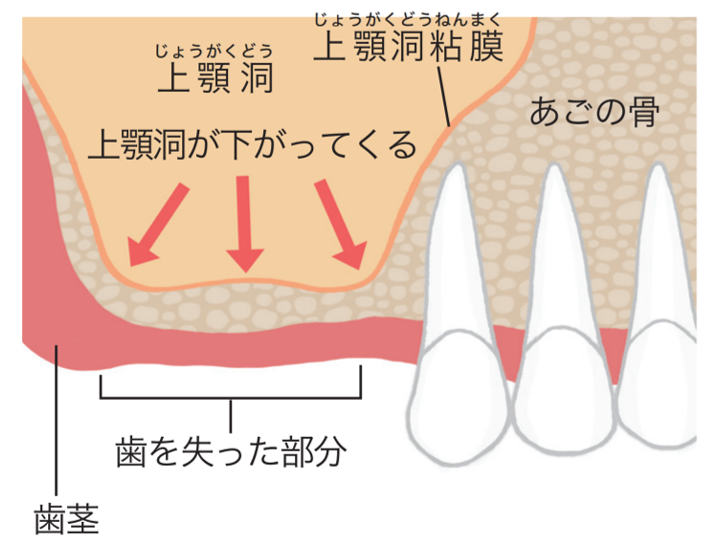 インプラント治療の例 難症例 インプラント治療の基本 国内初の歯科治療保証会社 ガイドデント インプラント治療の例 難症例 インプラント治療の基本 国内初の歯科治療保証会社 ガイドデント