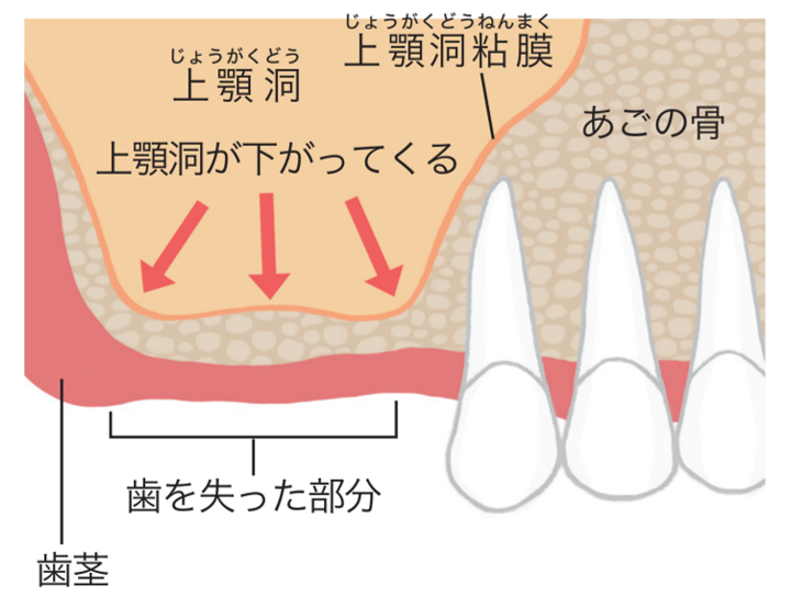 インプラント治療の例 （②難症例）