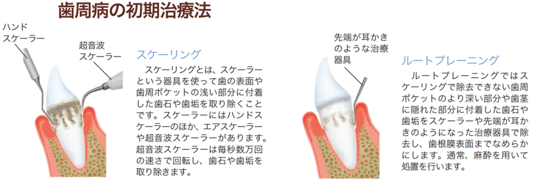 虫歯や歯周病がある場合、手術前に治療を済ませておきましょう。