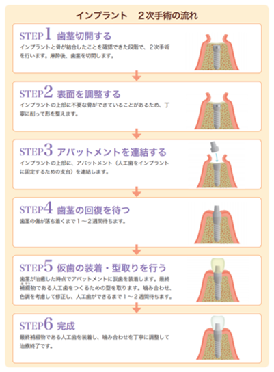 人工歯をインプラントと連結する２回法の２次手術とは？